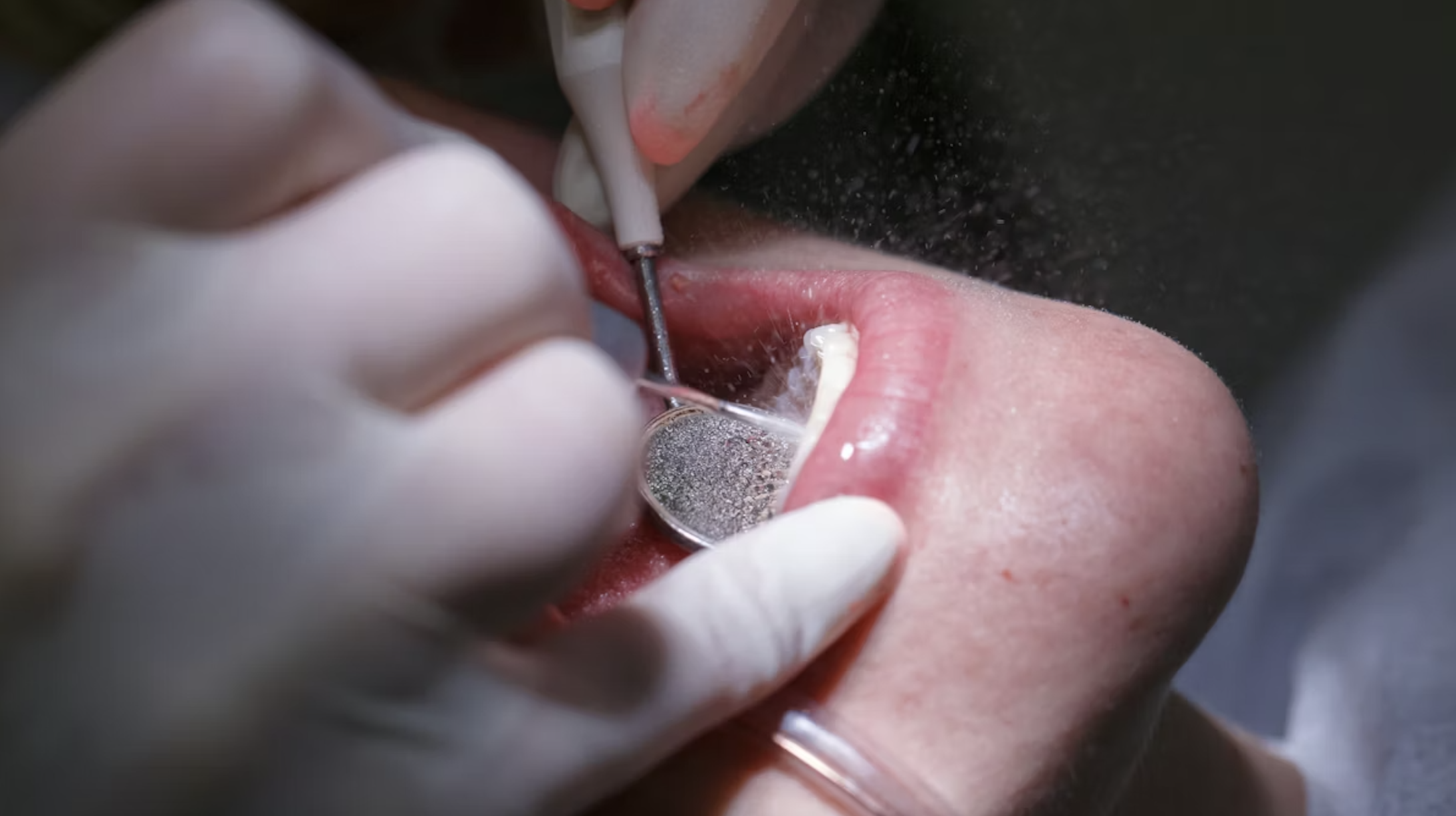 an-toan-nuoc-dieu-tri-ghe-nha-duwl